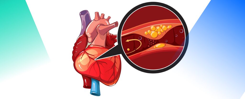 LS-DYNA Stent Simulation